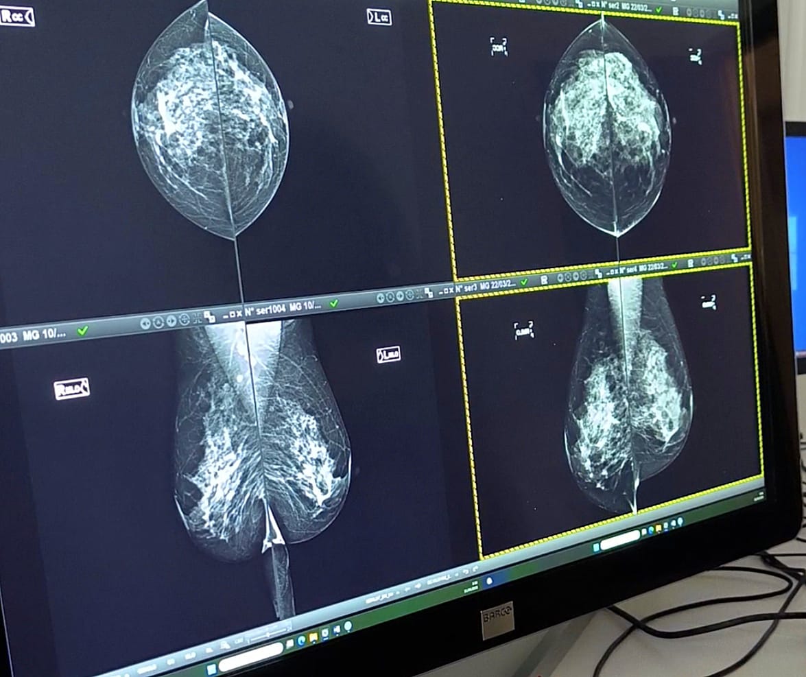 Imatge de mamografies.